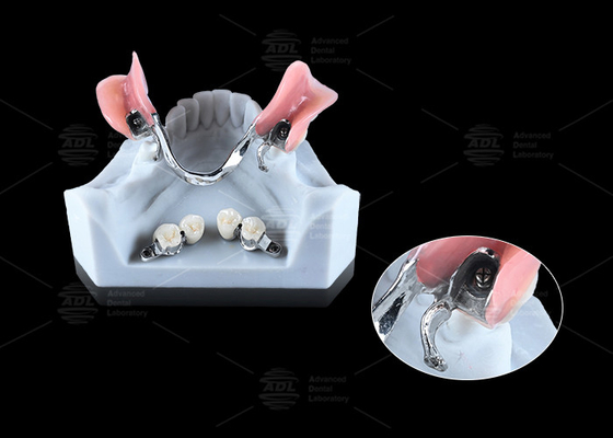 Купить 0.1mm Tolerance CEKA REVAX Attachment Titanium 3mm Вертикальный просвет Производство в сети