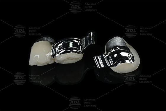 Купить Зуботехническая лаборатория Китая, регулируемый индивидуальный ключ для пациента, прецизионный аттачмент с металлокерамикой Производство в сети