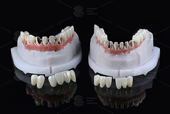 Купить Китайская стоматологическая лаборатория Титановый гибридный мост с полной аркой с немедленной загрузкой A1 Shade Malong Design Screw Retained Cad/Cam Производство в сети