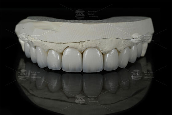 0.3mm-0.7mm Feldspathic EMAX Керамические фанеры Естественные Эстетические Emax Зубные фанеры